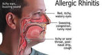 Laser-Light Rhinitis Red Therapy Device